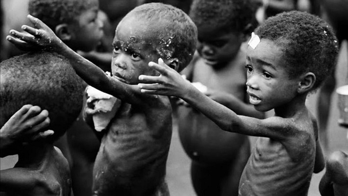 There is severe malnourished children in seven northern states