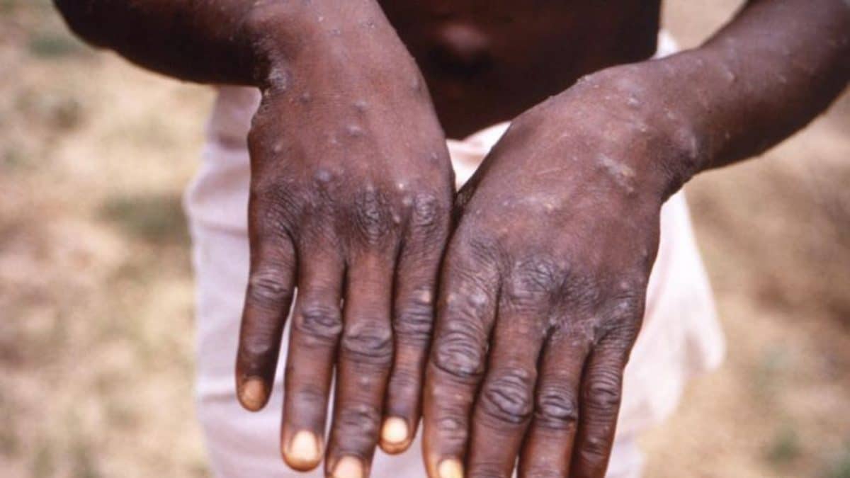 Rivers govt confirms two cases of Monkeypox